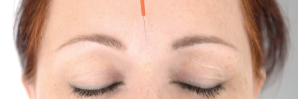 Facial Acupuncture - What You Need To Know